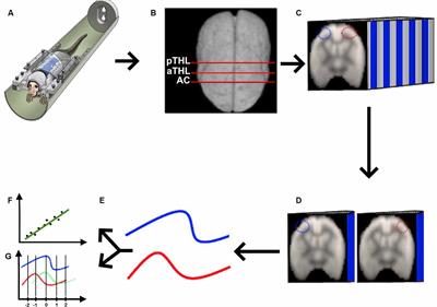 Dynamic Interhemispheric Desynchronization in Marmosets and Humans With Disorders of the Corpus Callosum